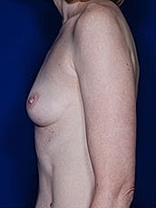 Breast Augmentation Before & After