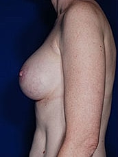Breast Augmentation Before & After