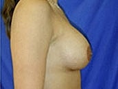 Breast Augmentation Before & After