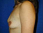 Breast Augmentation Before & After