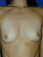 Breast Augmentation Before & After