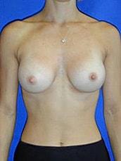 Breast Augmentation Before & After