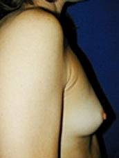 Breast Augmentation Before & After