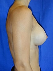 Breast Augmentation Before & After
