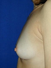 Breast Augmentation Before & After