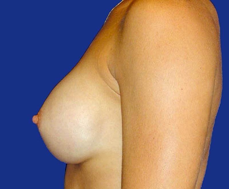 Breast Augmentation Before & After