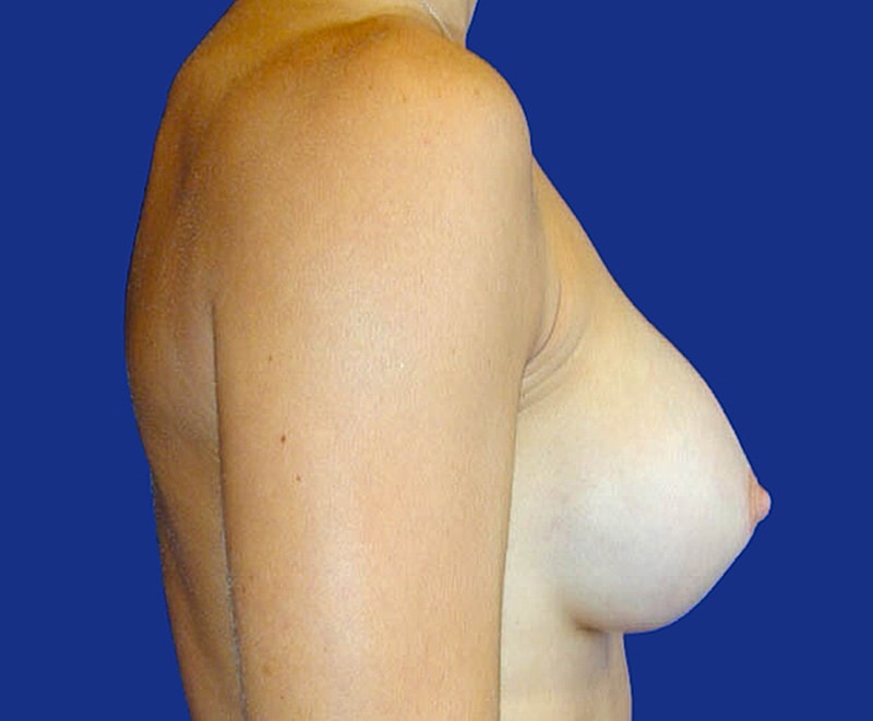 Breast Augmentation Before & After