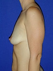 Breast Augmentation Before & After