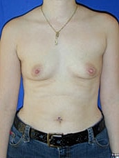Breast Augmentation Before & After