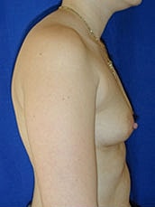 Breast Augmentation Before & After