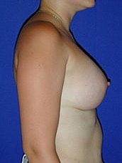 Breast Augmentation Before & After