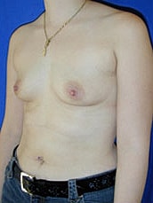 Breast Augmentation Before & After