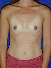 Breast Augmentation Before & After