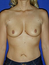 Breast Augmentation Before & After