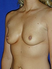 Breast Augmentation Before & After