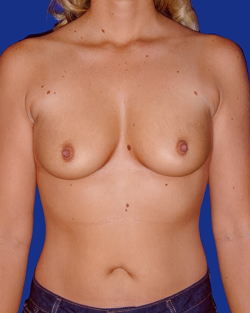 Breast Augmentation Before & After