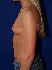 Breast Augmentation Before & After