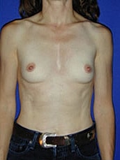 Breast Augmentation Before & After