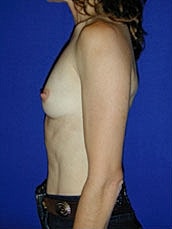 Breast Augmentation Before & After