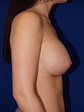 Breast Augmentation Before & After