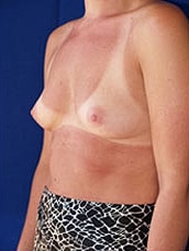 Breast Augmentation Before & After