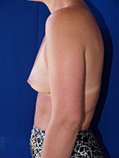 Breast Augmentation Before & After