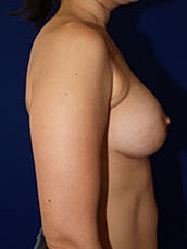 Breast Augmentation Before & After
