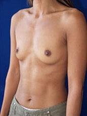 Breast Augmentation Before & After