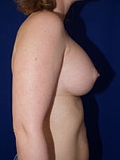 Breast Augmentation Before & After