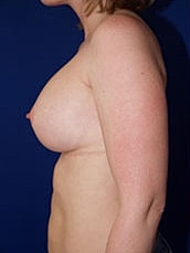 Breast Augmentation Before & After