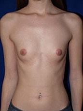 Breast Augmentation Before & After