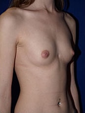 Breast Augmentation Before & After