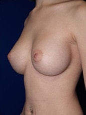 Breast Augmentation Before & After