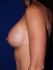 Breast Augmentation Before & After