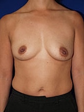 Breast Augmentation Before & After