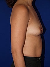Breast Augmentation Before & After