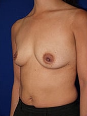 Breast Augmentation Before & After