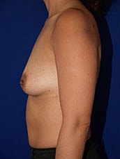 Breast Augmentation Before & After
