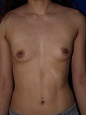 Breast Augmentation Before & After