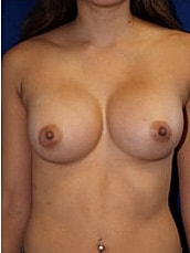 Breast Augmentation Before & After