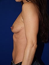 Breast Augmentation Before & After