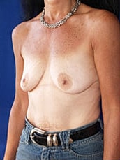 Breast Augmentation Before & After