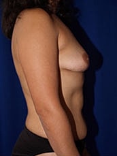 Breast Augmentation Before & After
