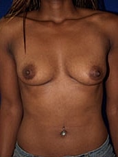 Breast Augmentation Before & After
