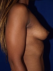 Breast Augmentation Before & After