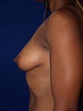 Breast Augmentation Before & After