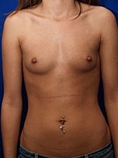 Breast Augmentation Before & After