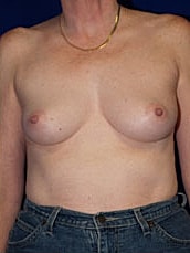 Breast Augmentation Before & After