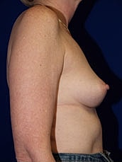 Breast Augmentation Before & After