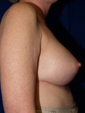 Breast Augmentation Before & After